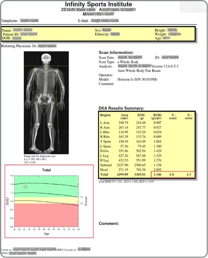 LATO AI Delta integrated DXA scan report showing full body bone density analysis, body composition metrics, and graphical summary for patient health assessment.